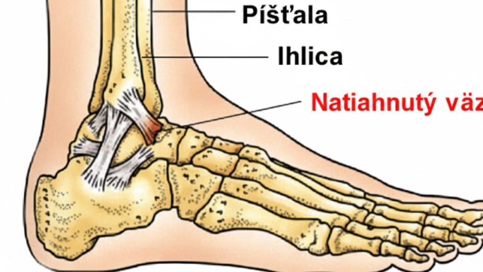natiahnutá šľacha (väz) na nohe